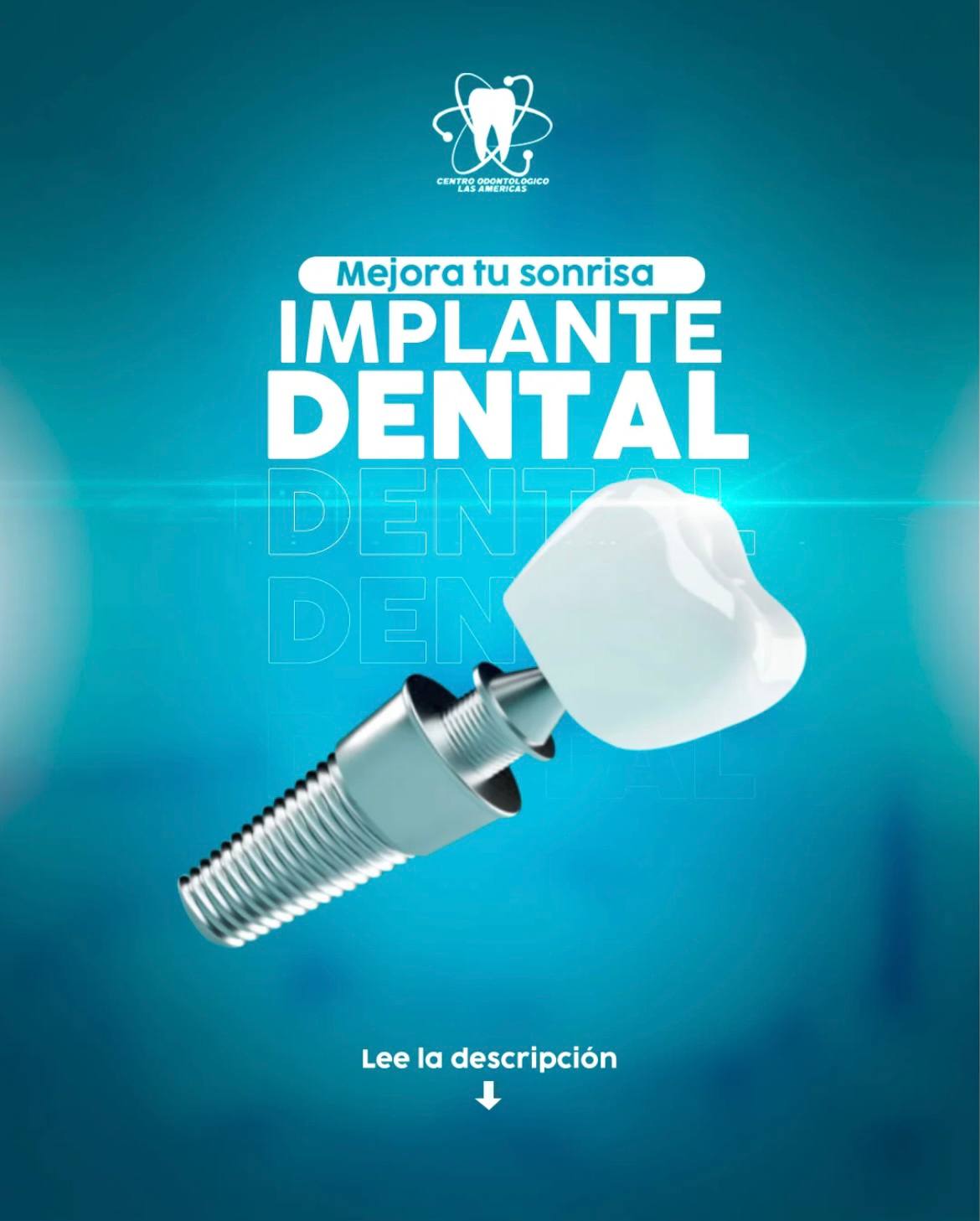Implante Dental